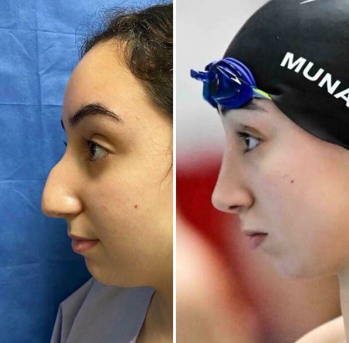 Side-by-side before and after plastic surgery images showing nose transformation in a young woman.