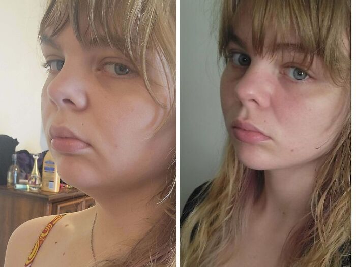 Side-by-side before and after plastic surgery photos showing facial transformation of a woman in natural light.