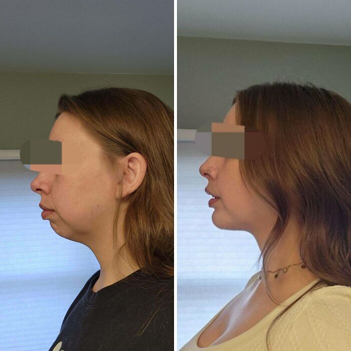 Side-by-side before and after plastic surgery photos showing facial transformation and profile enhancement.