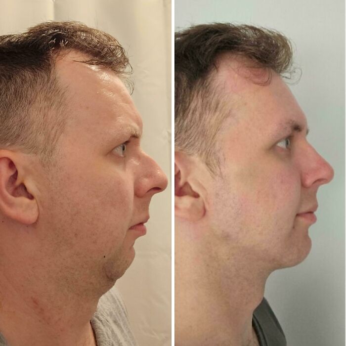 Before and after plastic surgery photos showing male facial transformation and contour improvement in profile view.