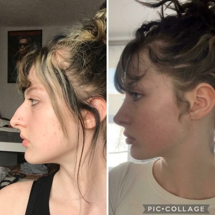 Side-by-side before and after plastic surgery photos showing a woman's facial transformation in Beverly Hills style.