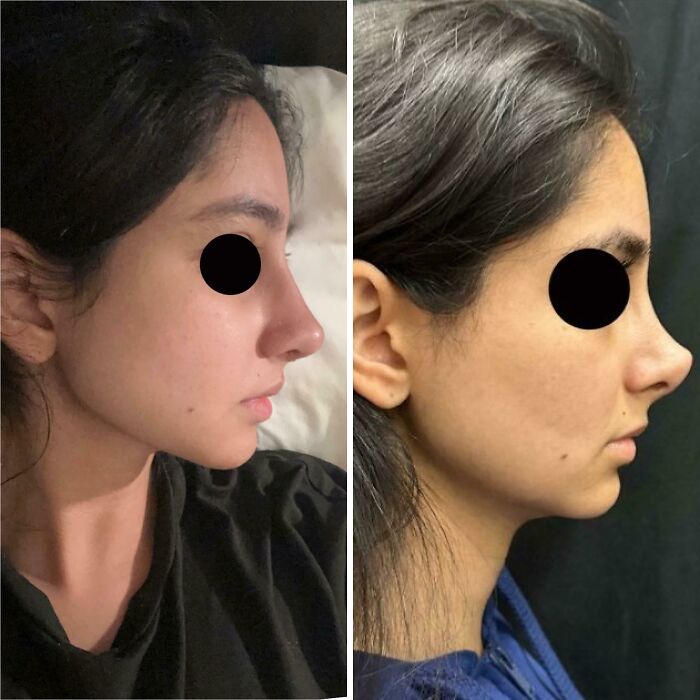 Side-by-side before and after plastic surgery profile images showing facial transformation of a woman.