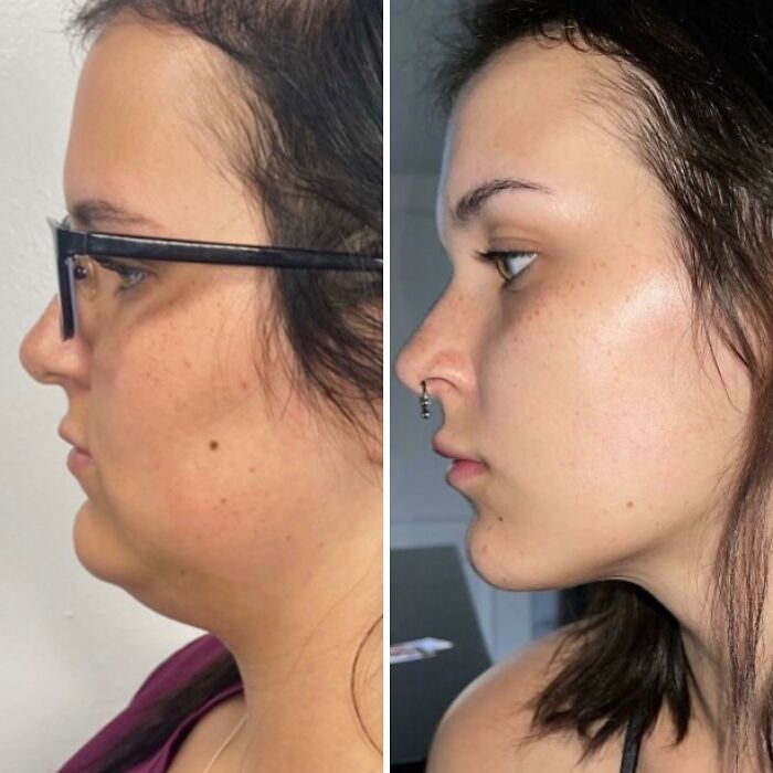 Side-by-side before and after plastic surgery photos showing facial transformation and contour improvement.