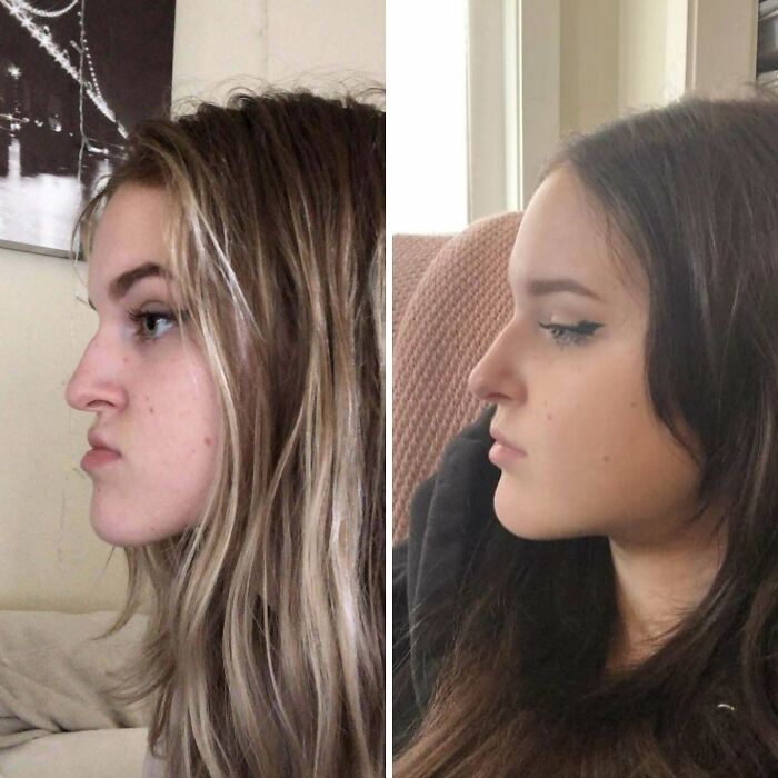 Before and after plastic surgery comparison of a young woman showing facial profile changes and cosmetic enhancement results.