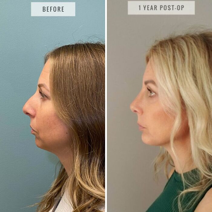 Side-by-side before and after plastic surgery photos showing facial transformation one year post-op.