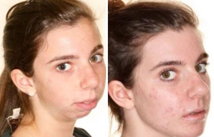 Before and after plastic surgery comparison of a young woman showing facial transformation and improvement in skin texture.