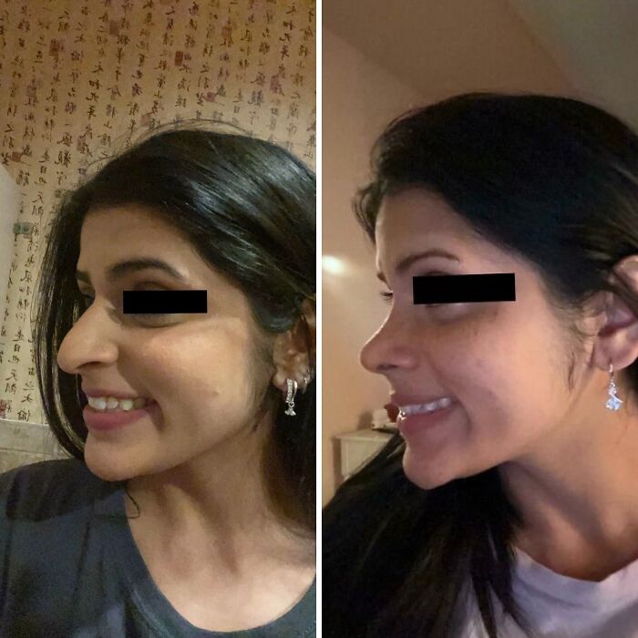 Side-by-side before and after plastic surgery photos showing nose transformation from a mom at Costco to Beverly Hills housewife.