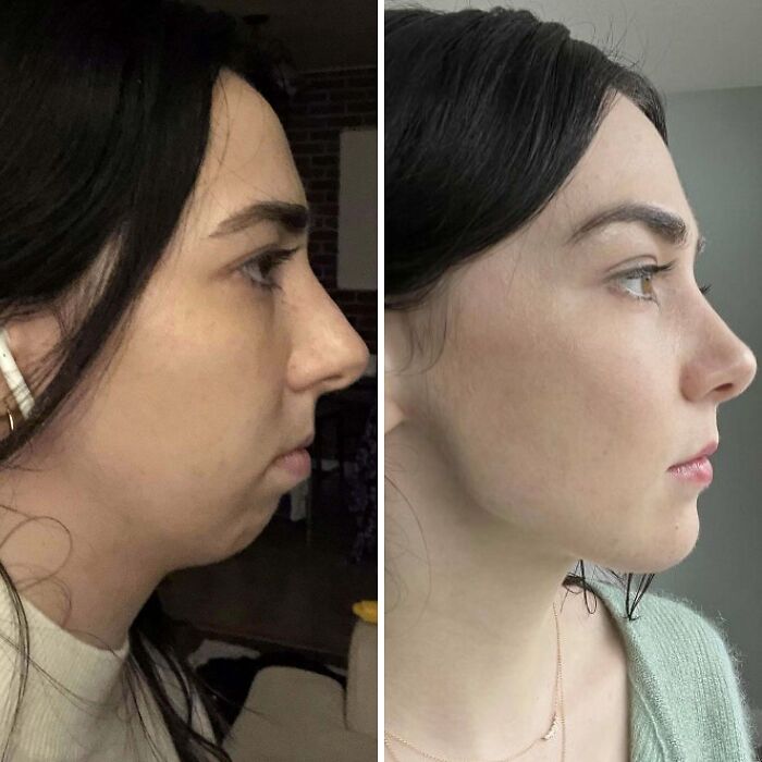 Before and after plastic surgery side profile of a woman showing facial transformation and contour improvement.