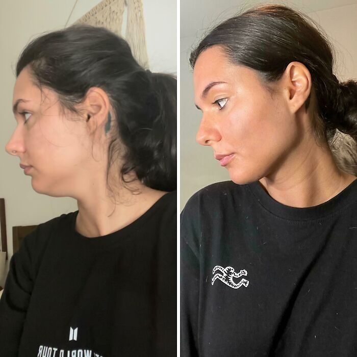 Side-by-side comparison of a woman before and after plastic surgery showing facial transformation and contour enhancement.