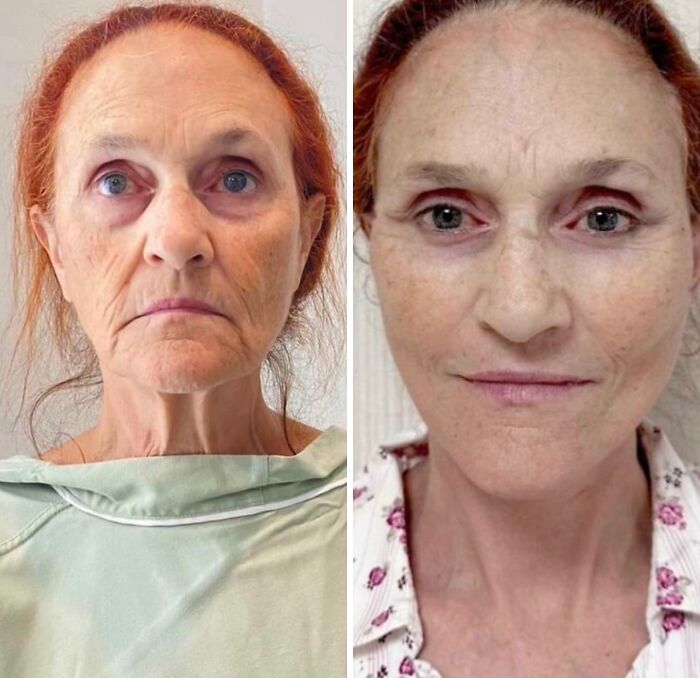 Before and after plastic surgery comparison of a woman showing significant facial rejuvenation and transformation results.