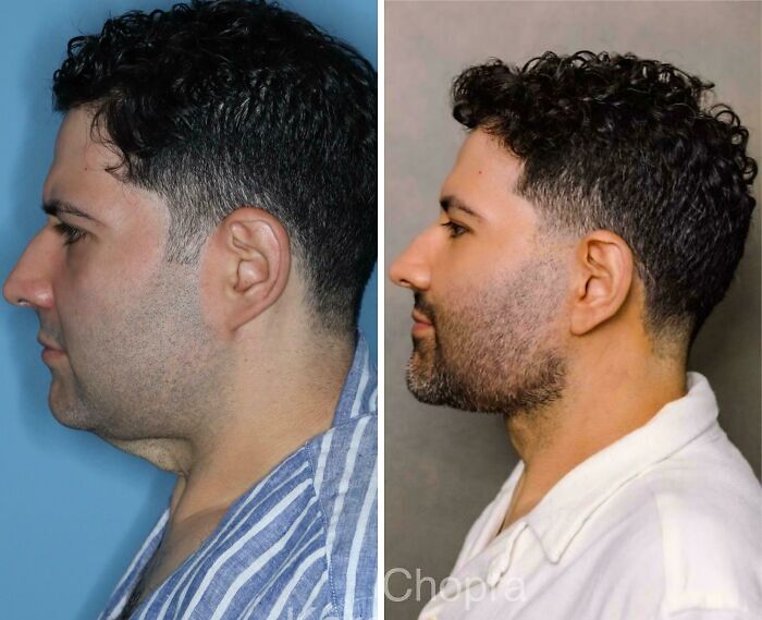 Side-by-side before and after plastic surgery photos showing facial transformation and contour improvement in a man.