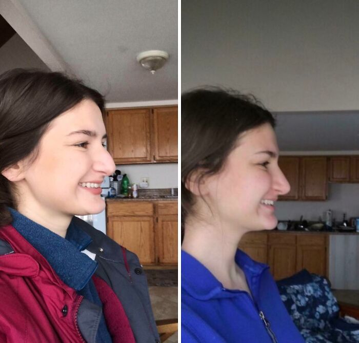 Side-by-side before and after plastic surgery photos showing a young woman’s profile transformation.