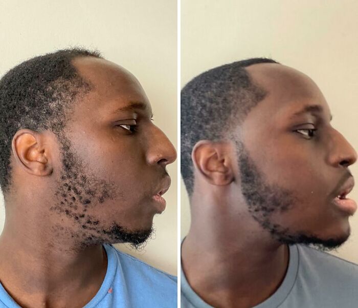 Before and after plastic surgery transformation showing improved facial hair growth and jawline enhancement in a side profile view.