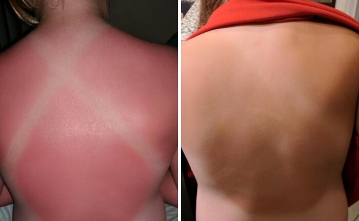 Comparison of severe sunburn and healed skin on a back, illustrating heatwave hacks for summer relief.