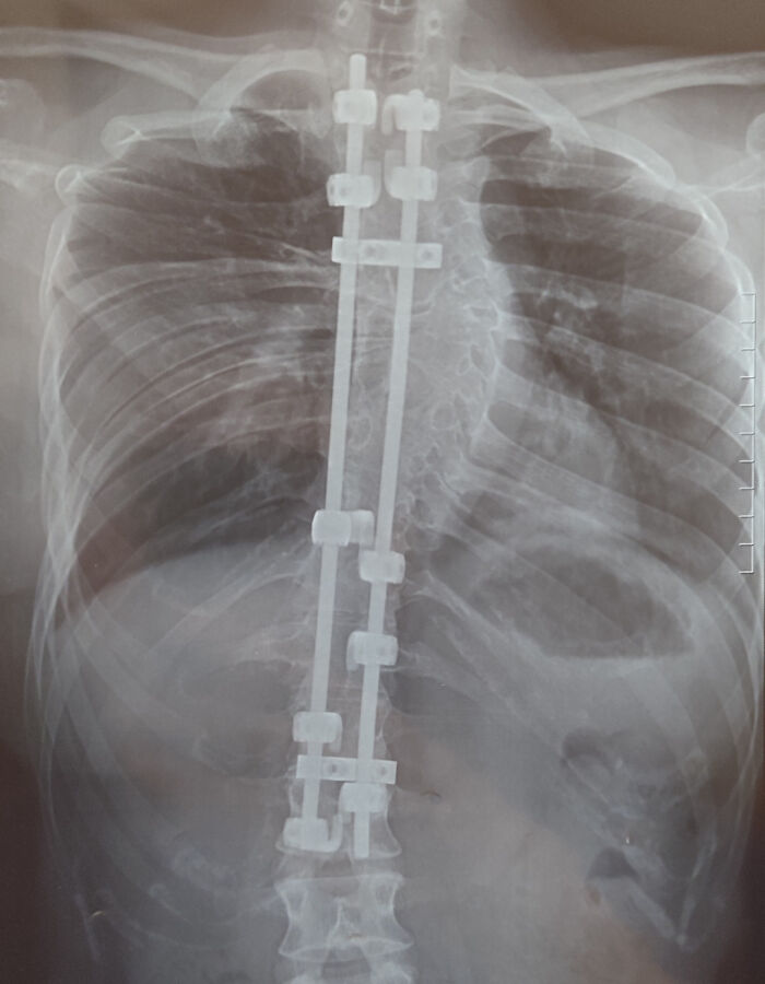 X-ray image showing surgical metal rods and screws implanted in the human spine, an unusual body condition.