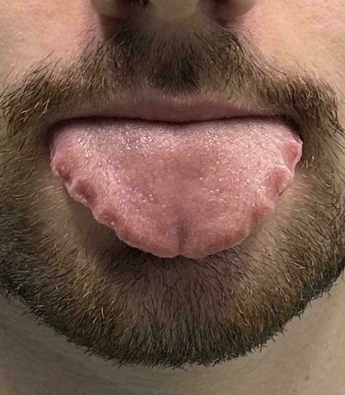 Close-up of a man's tongue showing unusual indentations along the sides, illustrating wild things that can happen to the human body.