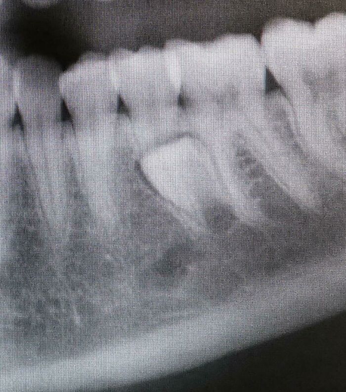 X-ray showing an extra tooth hidden among normal teeth, illustrating unusual human body variations.