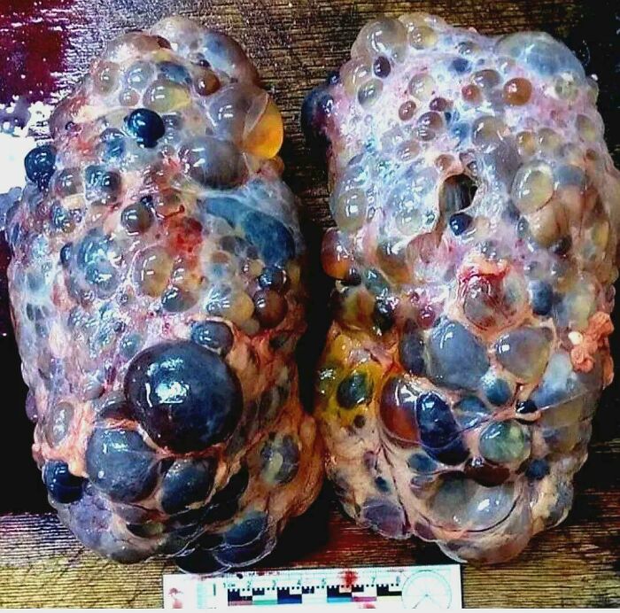 Two lobulated tissue masses covered in numerous bluish and yellow fluid-filled cysts on a board with scale, medical pics
