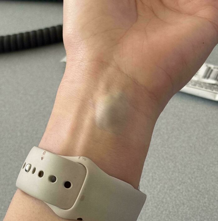 Close-up of a wrist showing a swollen bump, illustrating a fascinating human body condition.