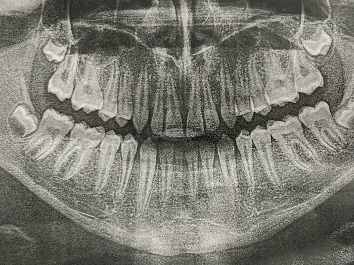 Panoramic dental X-ray showing an extra tooth in the lower jaw as a fascinating human body anomaly concept.