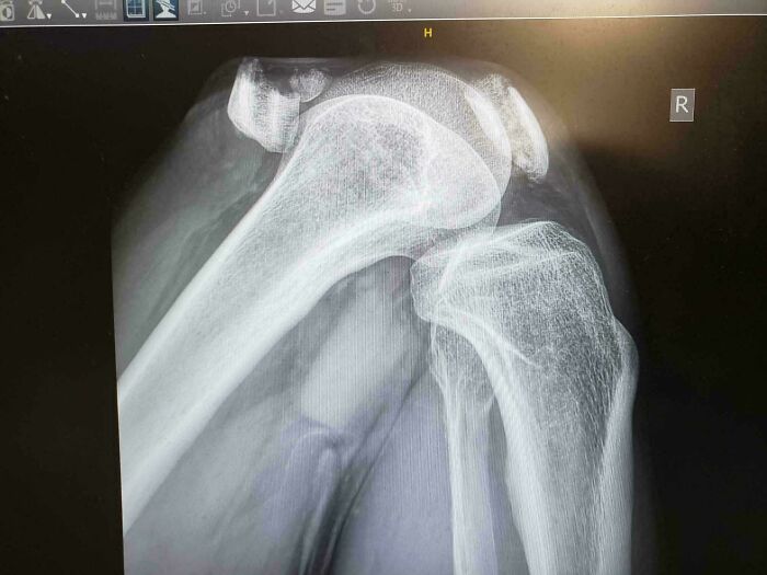 X-ray image of a human shoulder joint showing bones and possible extra finger anatomy details