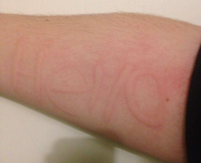 Faint scar on forearm showing the word Love, illustrating unusual marks that can appear on the human body.