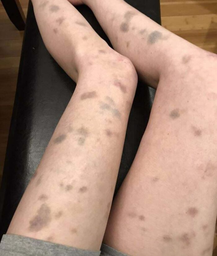 Legs with multiple dark bruises and spots, showing unusual skin marks related to wild things in the human body.