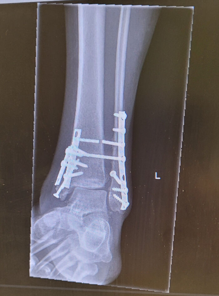 X-ray of a human ankle with metal screws and plates showing fascinating and wild things that can happen to the human body.
