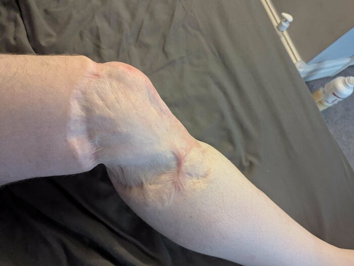 Close-up of a human forearm showing an extra finger growing near the wrist, illustrating unusual body anomaly.