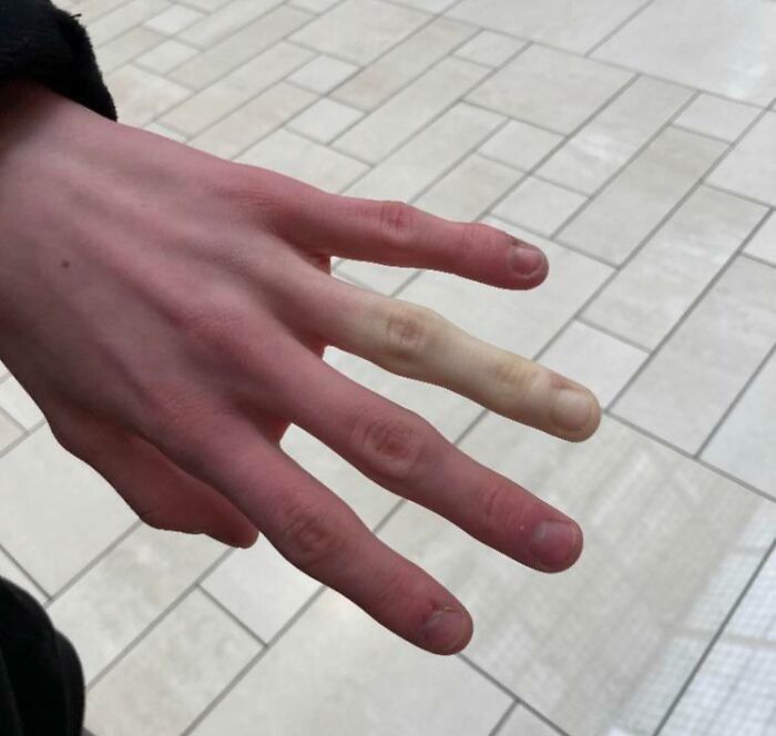 Close-up of a human hand with an extra finger showing unusual physical variation of the human body.