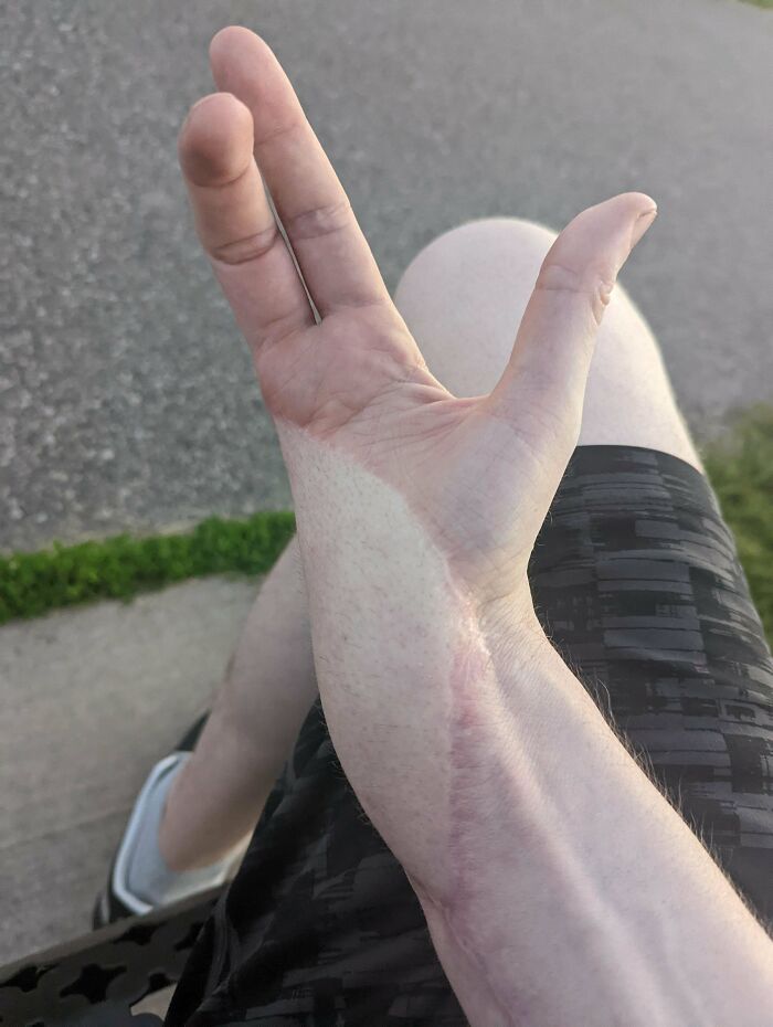 Mano extendida con rasgos distintivos del cuerpo humano visibles, mostrando venas y cicatriz en antebrazo.