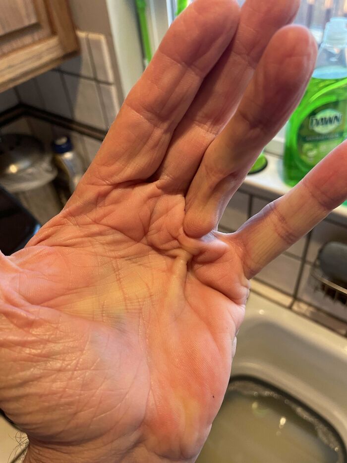 Close-up of a human hand showing an extra finger between the middle and ring fingers, highlighting a rare body anomaly.