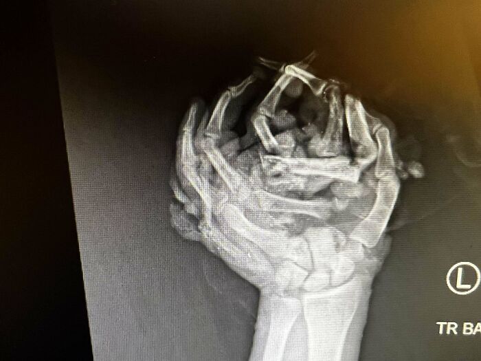 Radiografía del cuerpo humano mostrando rasgos distintivos de la mano en posición de puño cerrado.