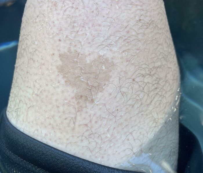 Close-up of an interesting birthmark on a hairy leg showing unique skin pigmentation and texture.
