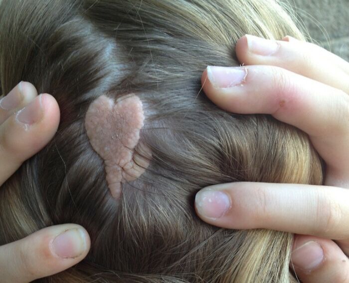 Close-up of a unique heart-shaped birth mark on a person’s scalp surrounded by blonde hair and fingers.