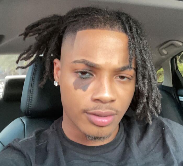 Young man with a unique and interesting birth mark on his cheek, sitting inside a car wearing a black shirt.