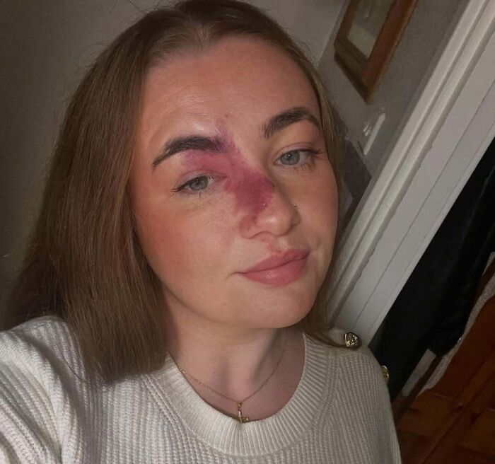 Young woman with a prominent red birthmark across her nose and cheek, showcasing unique and interesting birth marks.