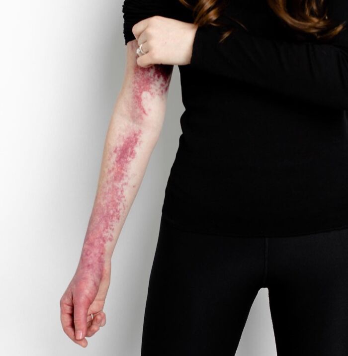 Person showing an amazing and interesting birthmark covering the forearm and wrist against a white background.
