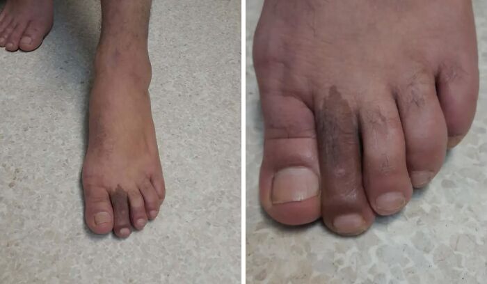 Close-up of feet showing a unique and interesting birth mark on the toes, highlighting natural skin variations.
