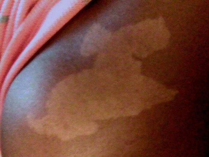 Close-up of a unique and interesting birth mark on a person's shoulder showcasing natural skin variation.