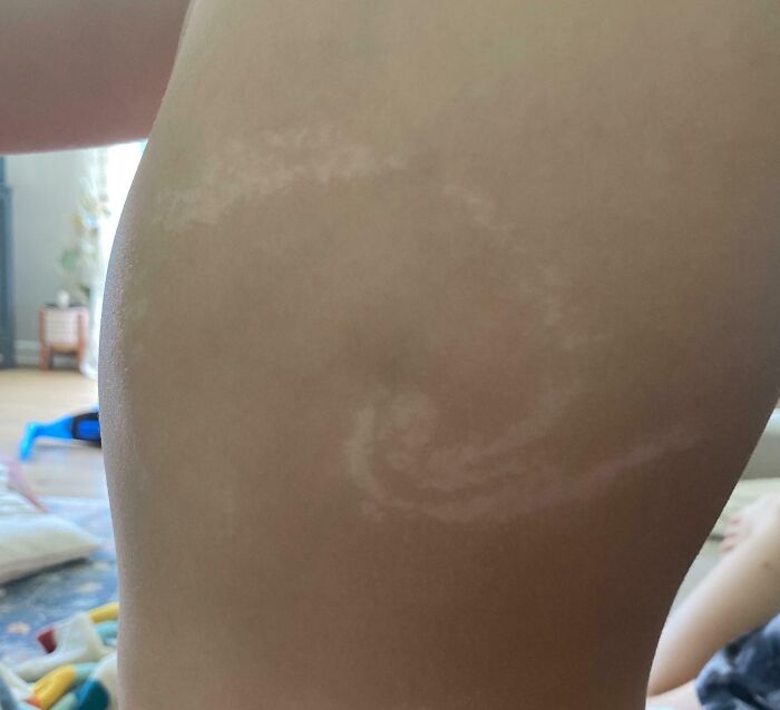 Close-up of a spiral-shaped birth mark on a person's skin, showcasing one of many interesting birth marks shared.