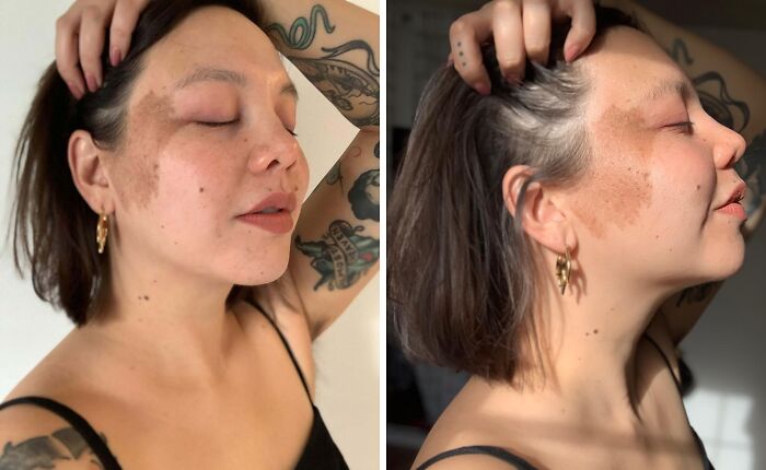 Woman with prominent birthmark on her cheek, posing in natural light, showcasing unique and interesting birth marks.