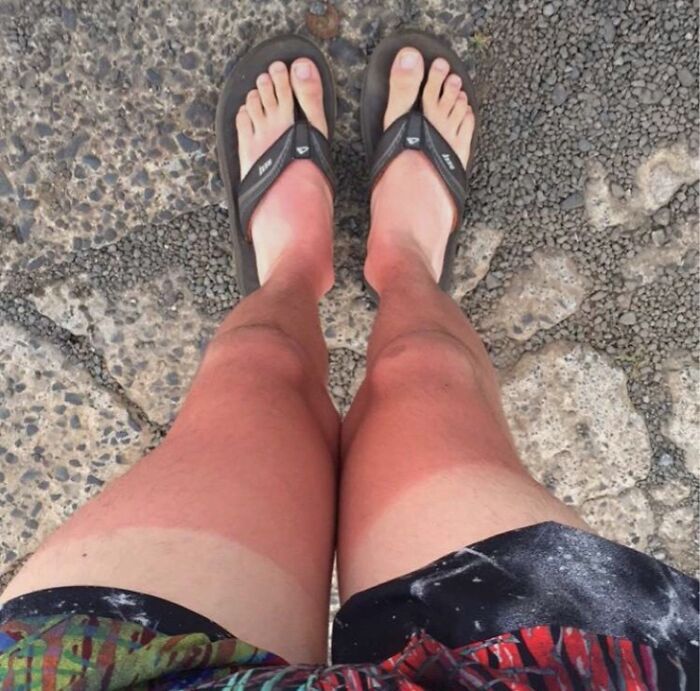 Sunburned legs with sharp tan lines from flip-flops, illustrating one funny way people learned their lesson about sun exposure.