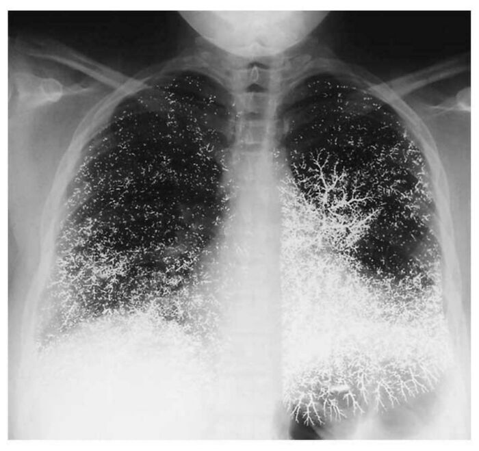 Chest X-ray showing diffuse branching white opacities throughout both lungs, medical pics