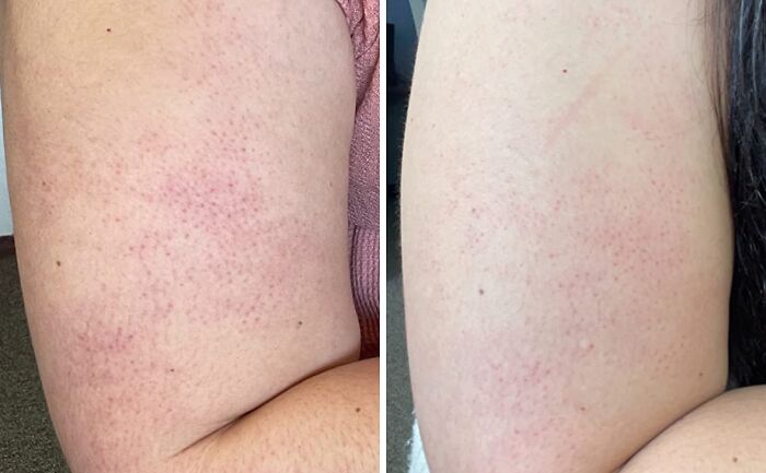 Close-up side-by-side comparison of skin showing changes, illustrating reasons to be grateful for discreet packaging benefits.