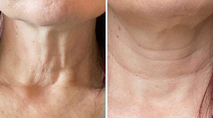 Close-up comparison of neck skin before and after treatment highlighting discreet packaging benefits and self-checkout ease.