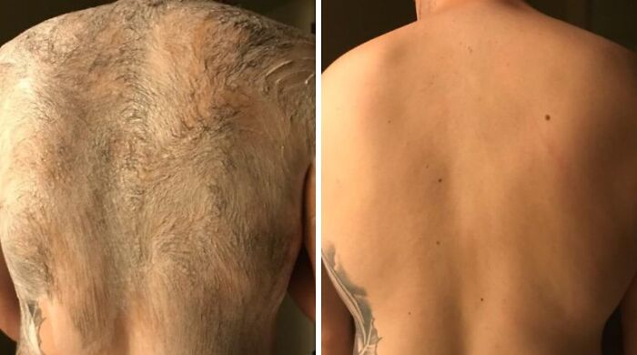 Before and after images showing a back hair removal transformation illustrating benefits of discreet packaging and self-checkout.