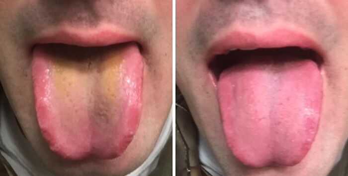 Close-up of a person's tongue before and after cleaning, illustrating hygiene benefits related to discreet packaging and self-checkout aisles.
