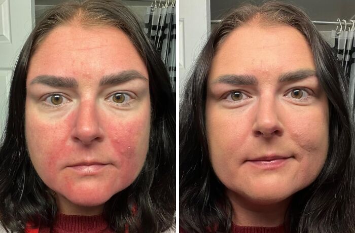 Side-by-side comparison of a woman’s face before and after skincare treatment, highlighting benefits of discreet packaging and self-checkout.
