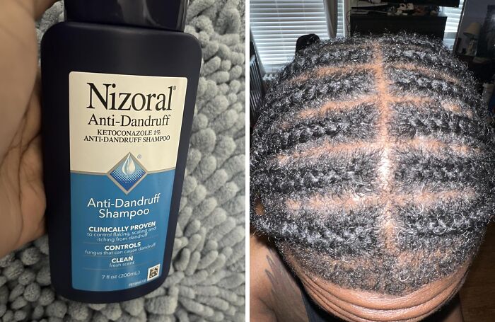 Hand holding anti-dandruff shampoo bottle next to a close-up of scalp with neatly styled hair at self-checkout aisle